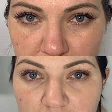 Jessner Chemical Peel Solution 35% – Professional Exfoliating - Product Imagery