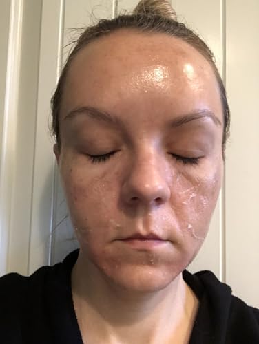 Jessner Chemical Peel Solution 35% – Professional Exfoliating - Product Imagery