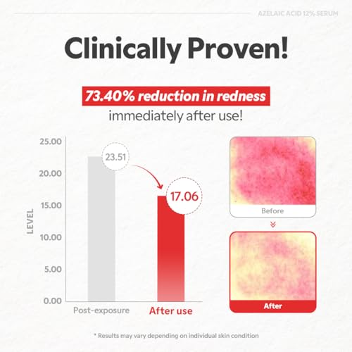 TIRTIR Azelaic Acid 12% Serum for Blemish-Prone Skin - Lightwe... - Product Imagery