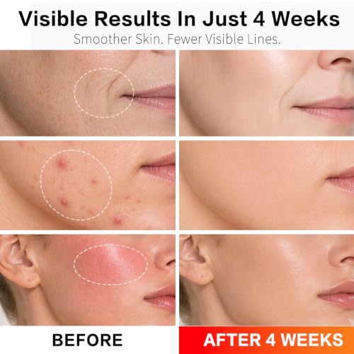 FDA-Cleared Red Light Therapy Mask for Face, 850nm NIR for Acne - Product Imagery