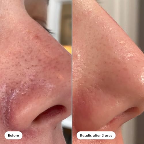 Hero Cosmetics Pore Release Blackhead Clearing Solution, 3.38 Fl - Product Imagery
