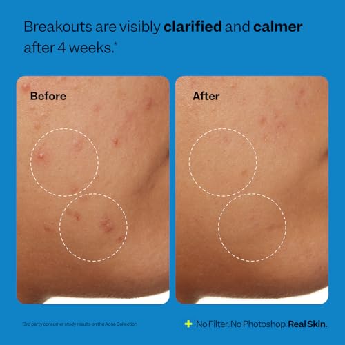 Peach Slices - Acne Clarifying Cleanser (4.05 oz) - 2% Salicyl... - Product Imagery