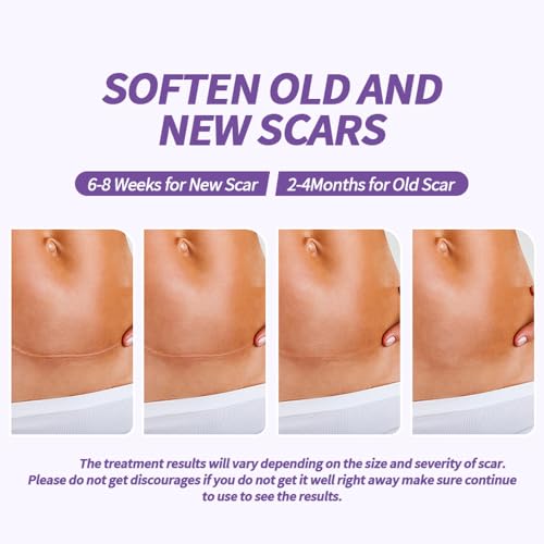 Medical Grade Silicone Scar Sheets, (1.6" x 60" Scar Roll-1.5M) - Product Imagery