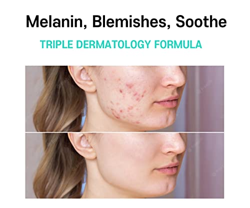 Melasma Treatment for Face Cream - Dark Spot Remover Cica - Product Imagery