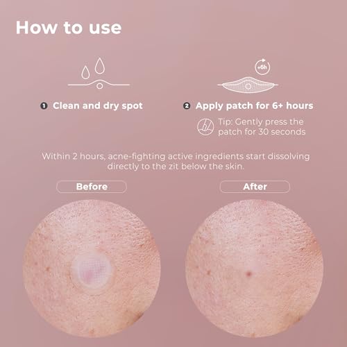 OMMA Korean Microdart Acne Patch, Cystic Acne Treatment, - Product Imagery