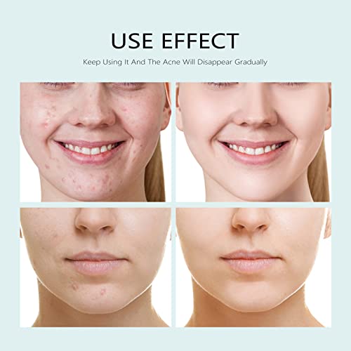 Facial Mask Anti Acne Face Masks Skin Care, Sheet Masks With - Product Imagery