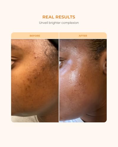 Buttah Skin 15% Vitamin C Serum 1 FL oz 30mL - For Uneven Skin - Product Imagery