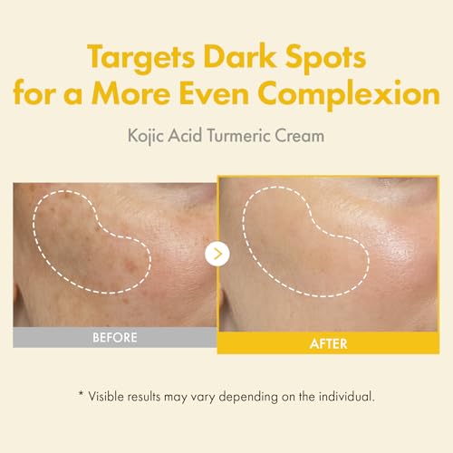 TOSOWOONG Kojic Acid Turmeric Cream for Dark Spots & - Product Imagery