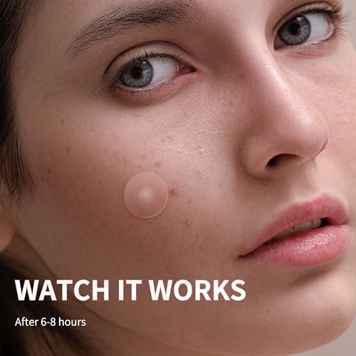 Pimple Patches for Face, 4 Size 300 Counts Hydrocolloid Acne - Product Imagery