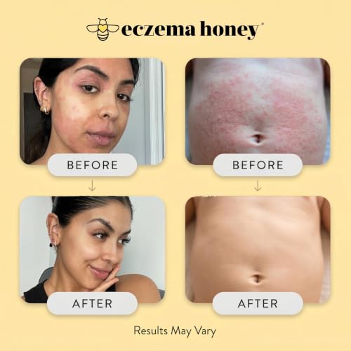 ECZEMA HONEY Original Skin-Soothing Cream for Dry Itchy Skin (4 - Product Imagery