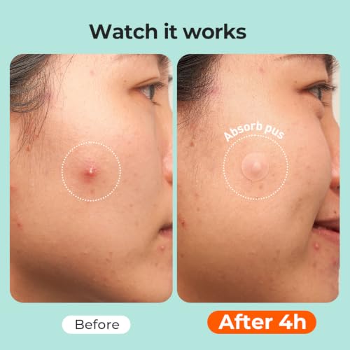 TKTK 443 Count Pimple Patches for Face, Hydrocolloid Acne Cover - Product Imagery