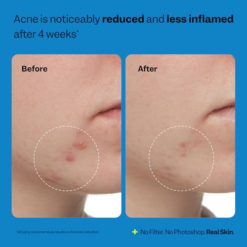Peach Slices - Acne Exfoliating Toner (4.05 oz) - 2% Salicylic... - Product Imagery