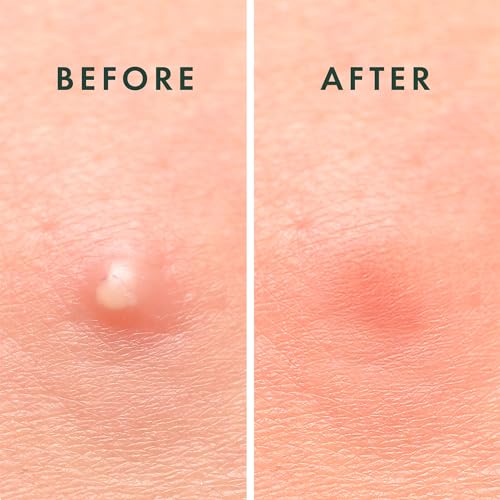 Rael Miracle Invisible Spot Cover Hydrocolloid Acne Pimple Pat... - Product Imagery