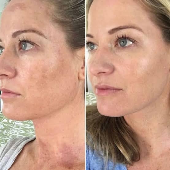 Azzy’s 20% Jessner Chemical Peel - Maximum Professional Strength - Product Imagery