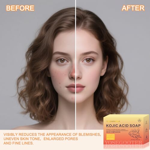 Kojic Acid Soap 4 Packs 14oz,Turmeric Soap, Dark Spot Remover - Product Imagery