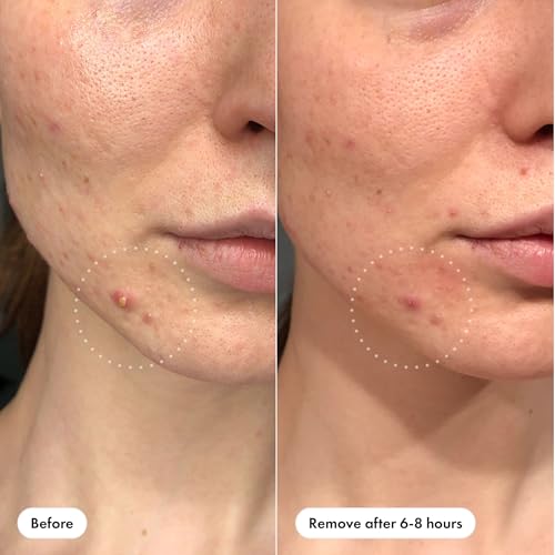 Hero Cosmetics Mighty Patch Invisible+ Daytime Acne Pimple - Product Imagery