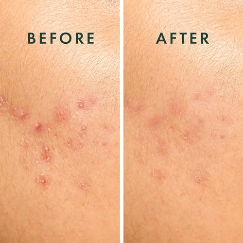 Rael Miracle Spot Control Cover Hydrocolloid Strips Pimple Pat... - Product Imagery