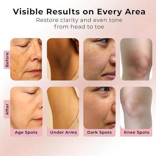 Dermacyl Dark Spot Remover for Face & Body with Azelaic Acid, - Product Imagery