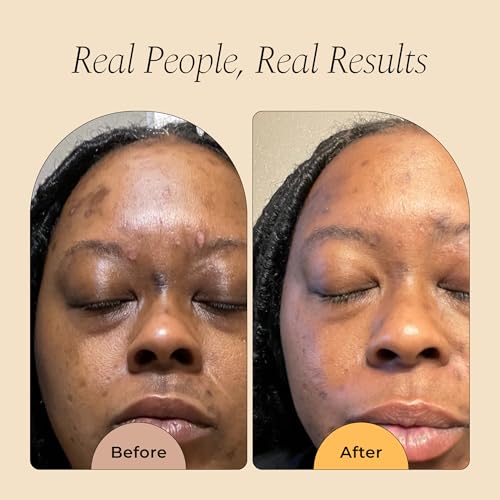 Glo Melanin Dark Spot Remover for Face - Dark Spot Corrector - Product Imagery