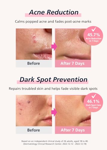 EasyDerm Real Calming Microdart Pimple Patch 4 packs(24ea) - - Product Imagery