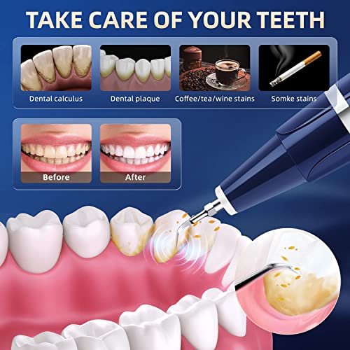 Plaque Remover for Teeth - Tartar Remover for Teeth, Dental - Product Imagery