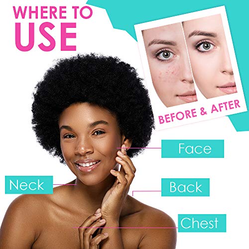 Bye Bye Blemish Acne Drying Lotion, Reduce Pimples Overnight, - Product Imagery