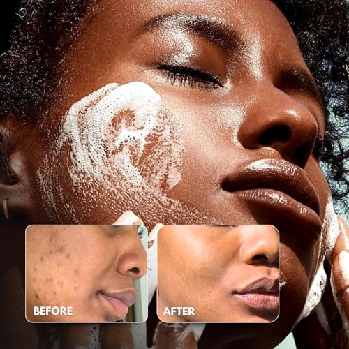 Organic Kojic Acid Turmeric Soap for Dark Spots, - Product Imagery