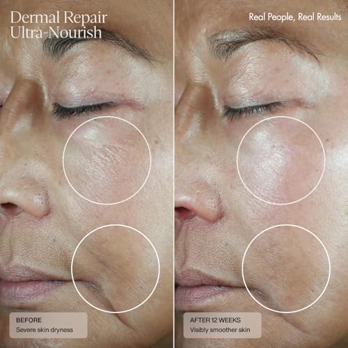 Senté Dermal Repair Ultra-Nourish | Rosacea Treatment for Dry, - Product Imagery