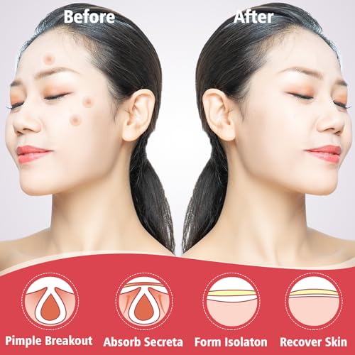 450 Pimple Patches for Face, Hydrocolloid Acne Patches for Zit - Product Imagery