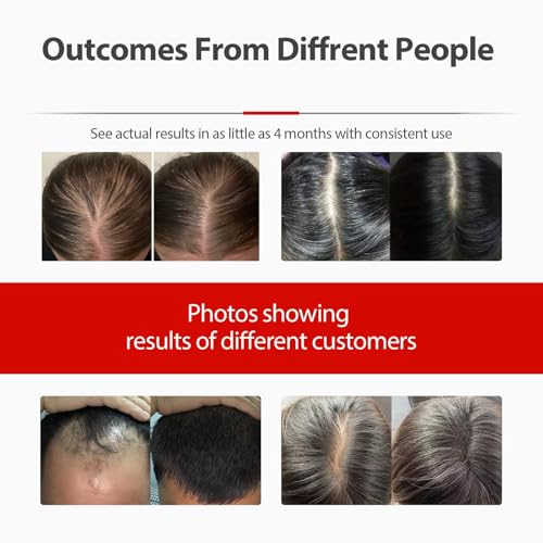 2026 Upgrade Laser Cap, Red Light Therapy for Hair, Red Light - Product Imagery