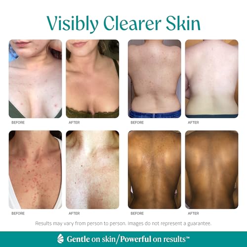 Almond Clear Mandelic Acid Level 2 Serum – Extra Strength - Product Imagery