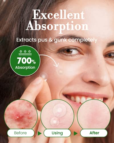 Invisible Pimple Spot Patch - 96 Ultra Thin Acne Patches - Easy - Product Imagery