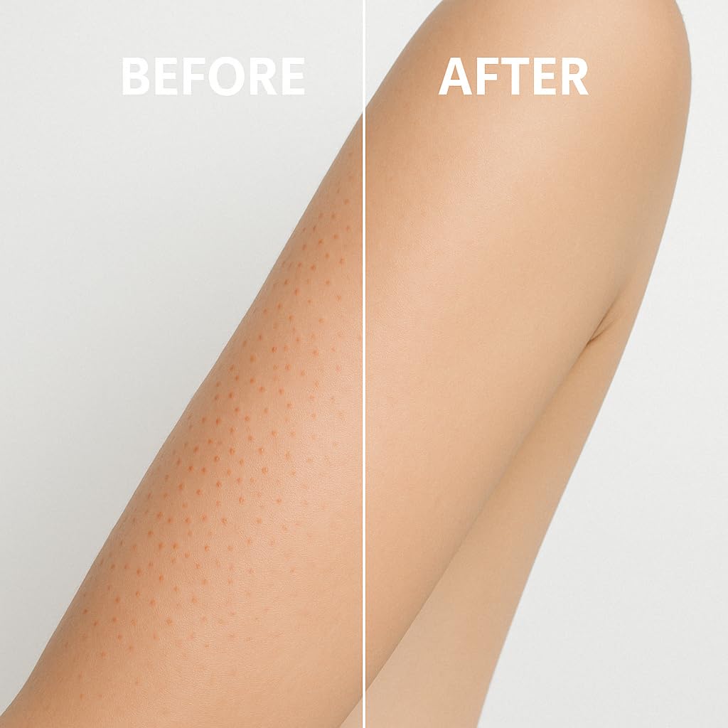 EVERCLEARNOW Microdermabrasion Keratosis Pilaris, Folliculitis & Acne - EVERCLEARNOW Official Product View 4