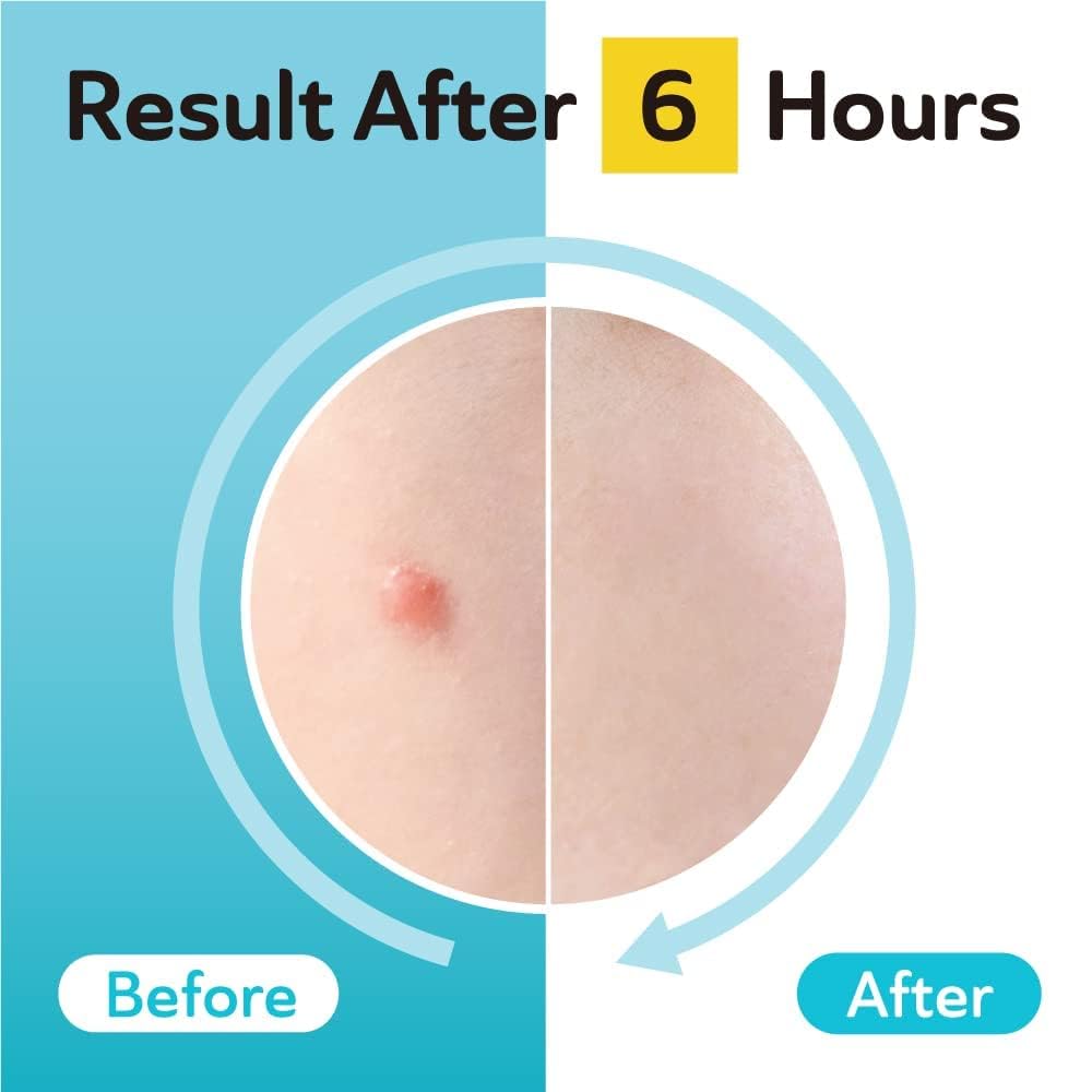 Dark Spot Patches Blemish Patches with Hydrocolloid TXA CICA - DERMA ANGEL Official Imagery - 8