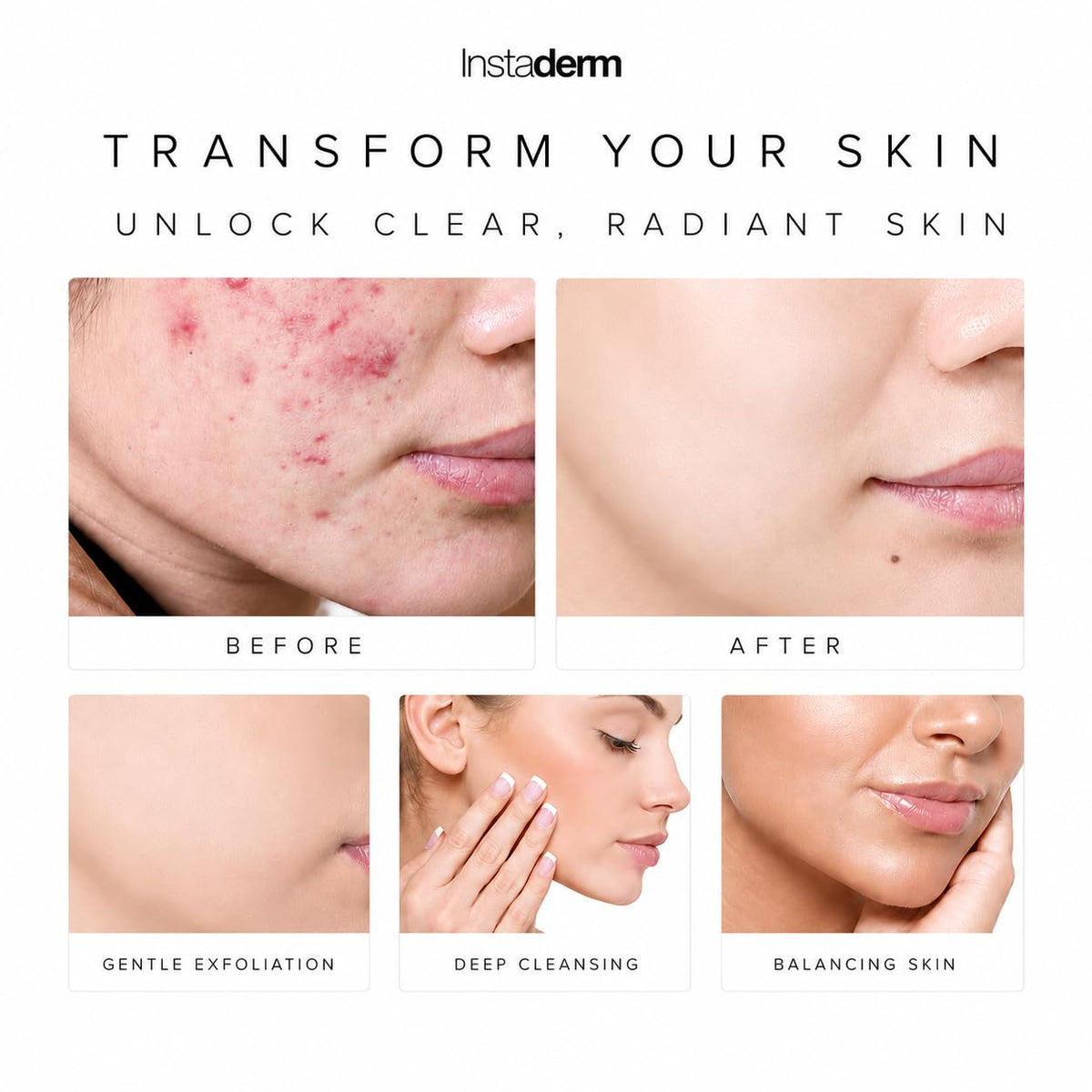 Acne Treatment Pads with Salicylic Glycolic Lactic Acid - Instaderm Official Imagery - 4