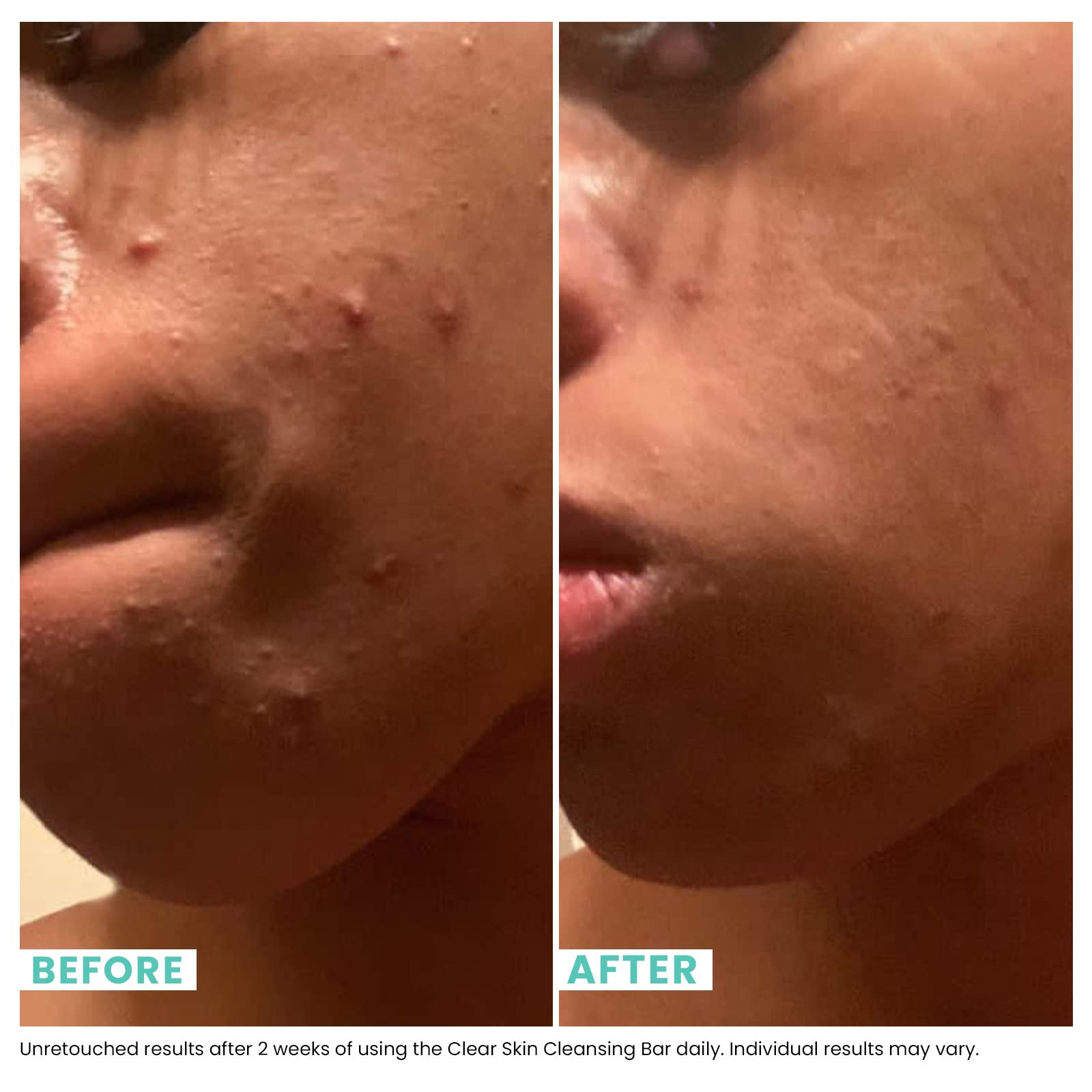 Urban Skin Rx Clear Skin 3 - 1 Daily Treatment Cleansing Bar & Exfo - Urban Skin Rx Official Product View 6