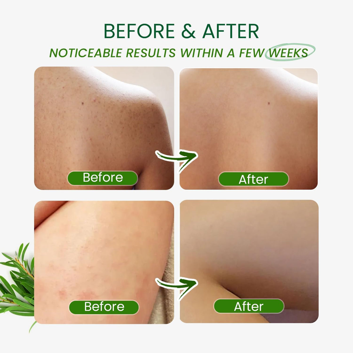 PHARMBANNER Tea Tree Antifungal Body Wash Soothes - PHARMBANNER Official Imagery - 6