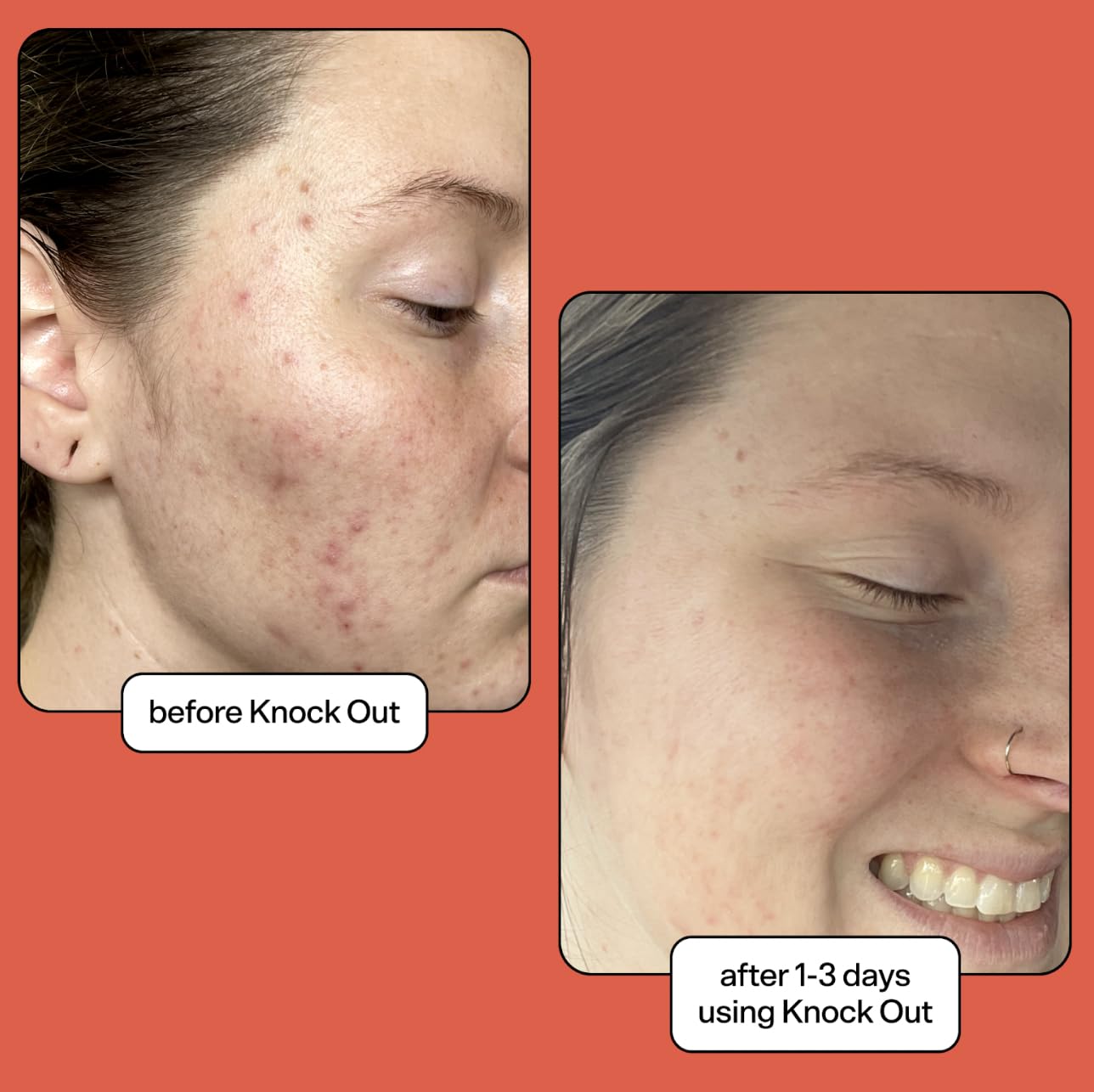 Bubble Skincare Knock Out 1.8% Salicylic Acid Acne Spot Treatment - Bubble Skincare