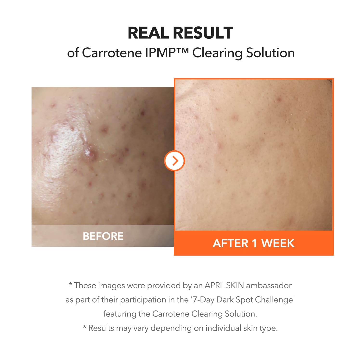 APRILSKIN Carrotene IPMP Clearing Solution - APRILSKIN
