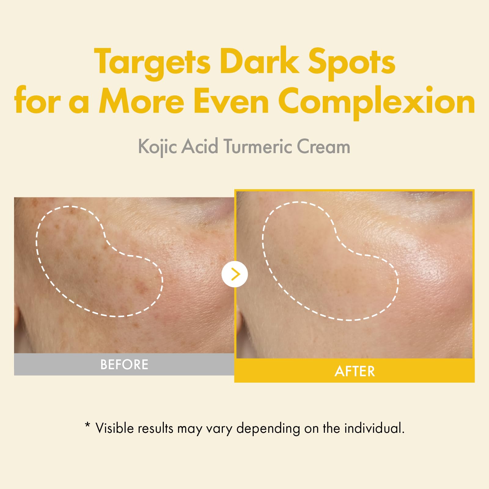 TOSOWOONG Kojic Acid Turmeric Cream for Dark Spots &amp; - TOSOWOONG