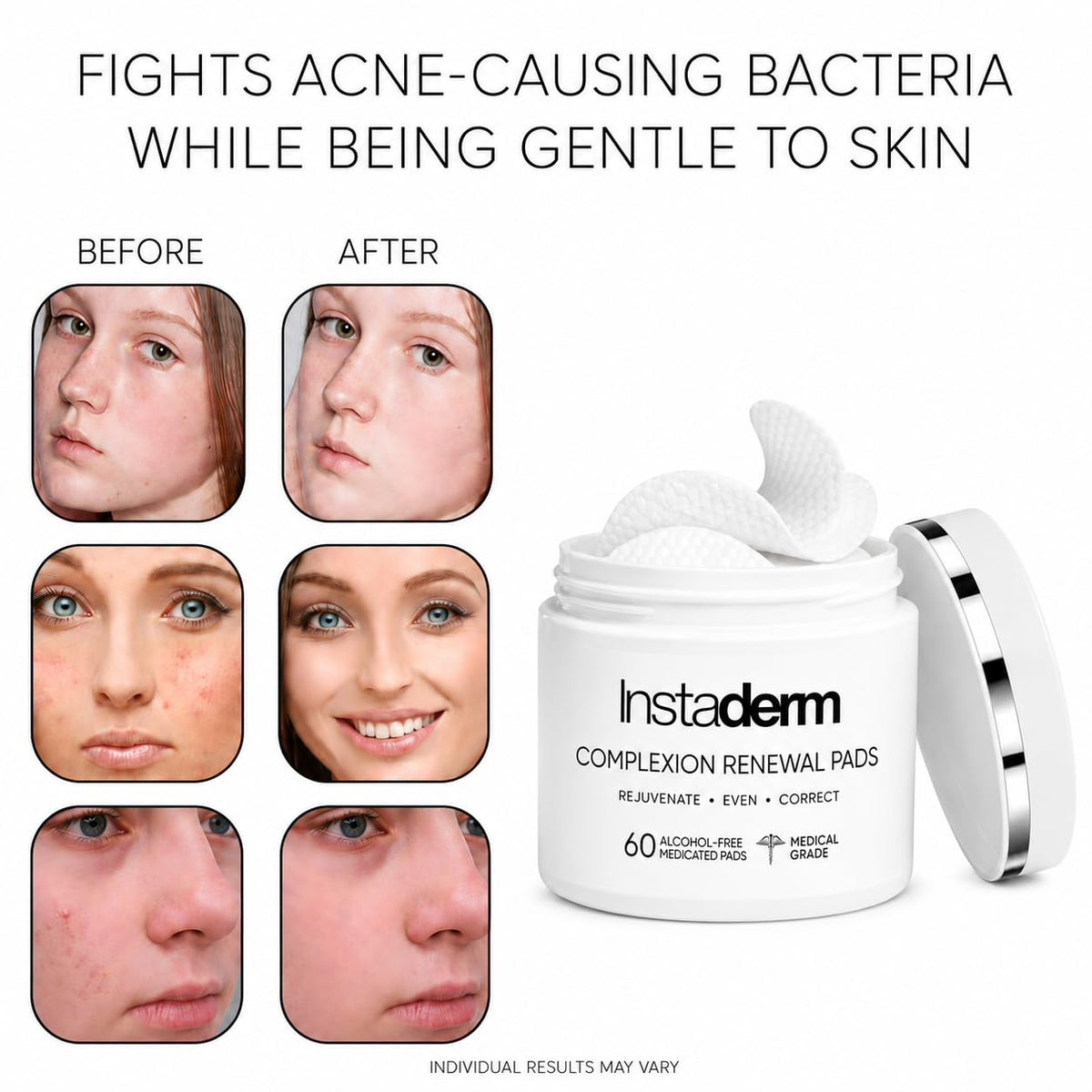 Acne Treatment Pads with Salicylic Glycolic Lactic Acid - Instaderm Official Imagery - 6