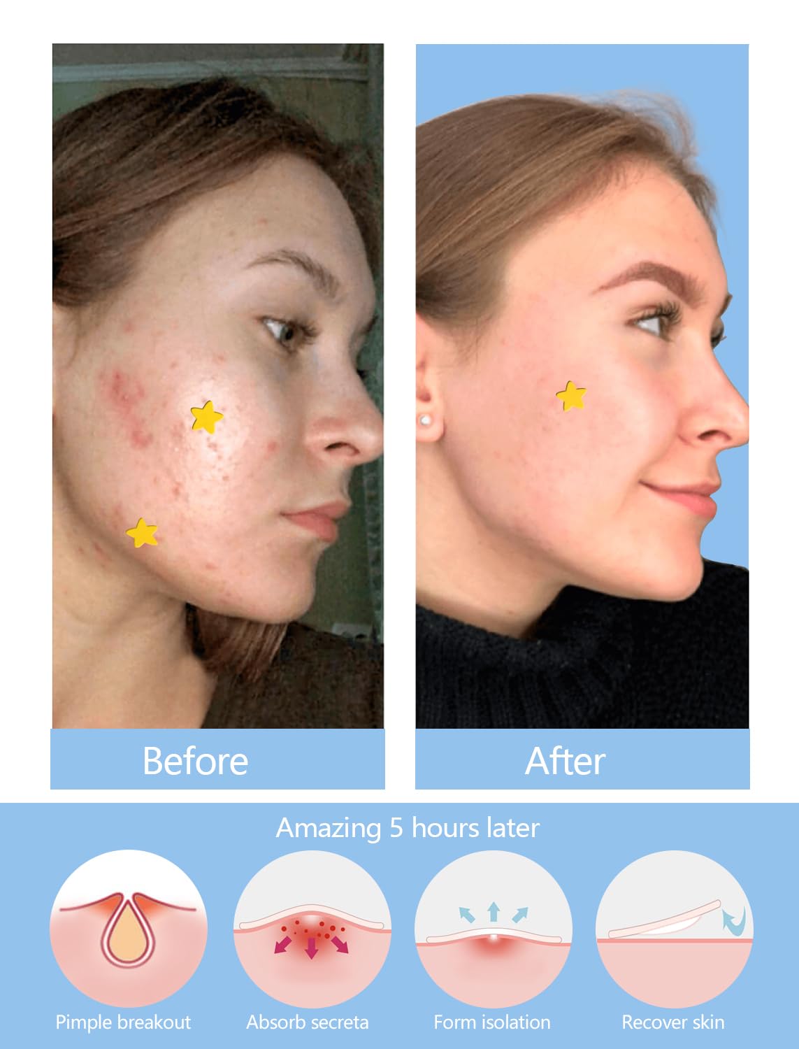 Yellow Star Pimple Patches for Face, 153 Count Hydrocolloid Star Acne Patches Invisible, Cute Zit Covers for Face, Spot Stickers with Tea Tree, Salicylic Acid and Cica Oil - SVIPTP Official Product View 7