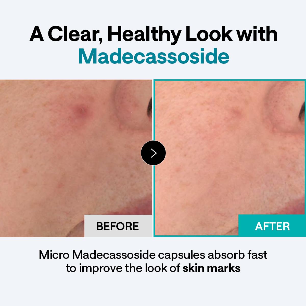 MEDIHEAL Madecassoside Derma Cream for Blemish Repair & Calming (50ml) - MEDIHEAL Official Product View 4