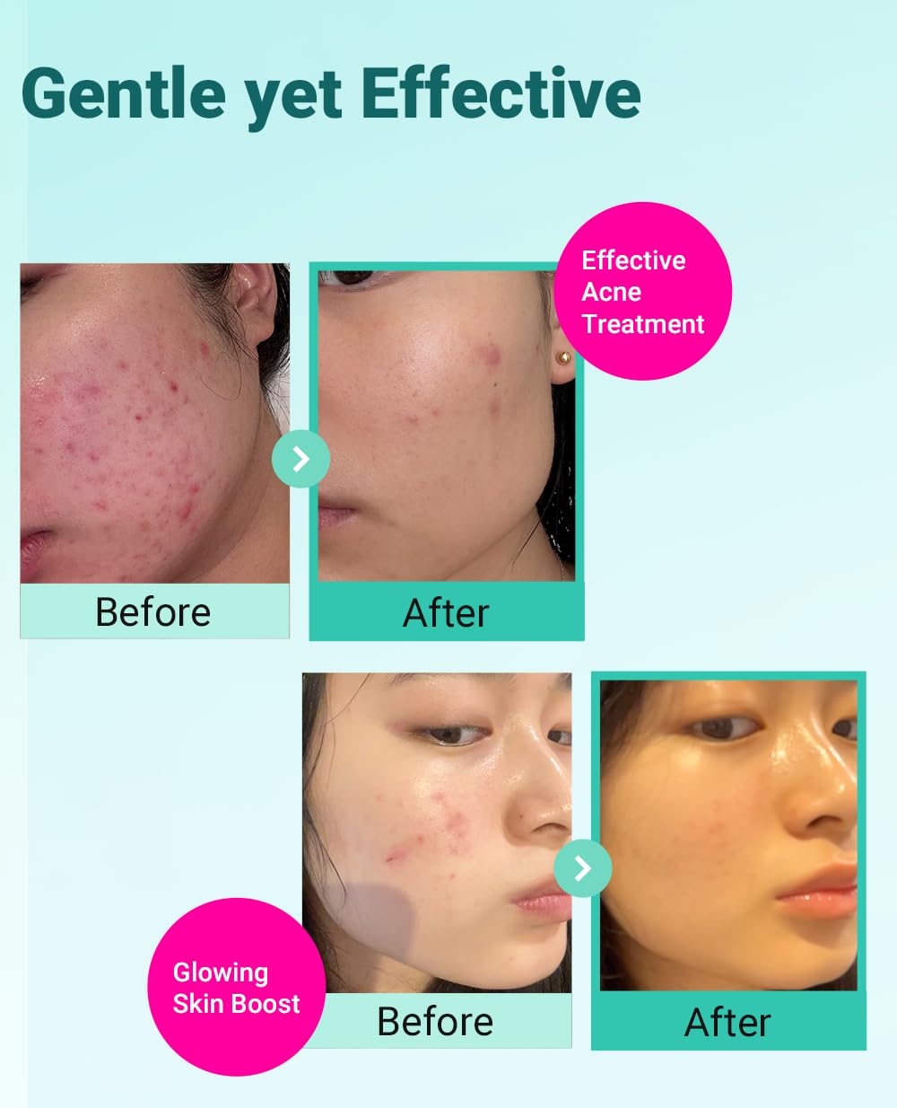 BRING GREEN TEA TREE CICA SET - Kit for Acne Prone & Sensitive Skin Zi - BRING GREEN Official Product View 5