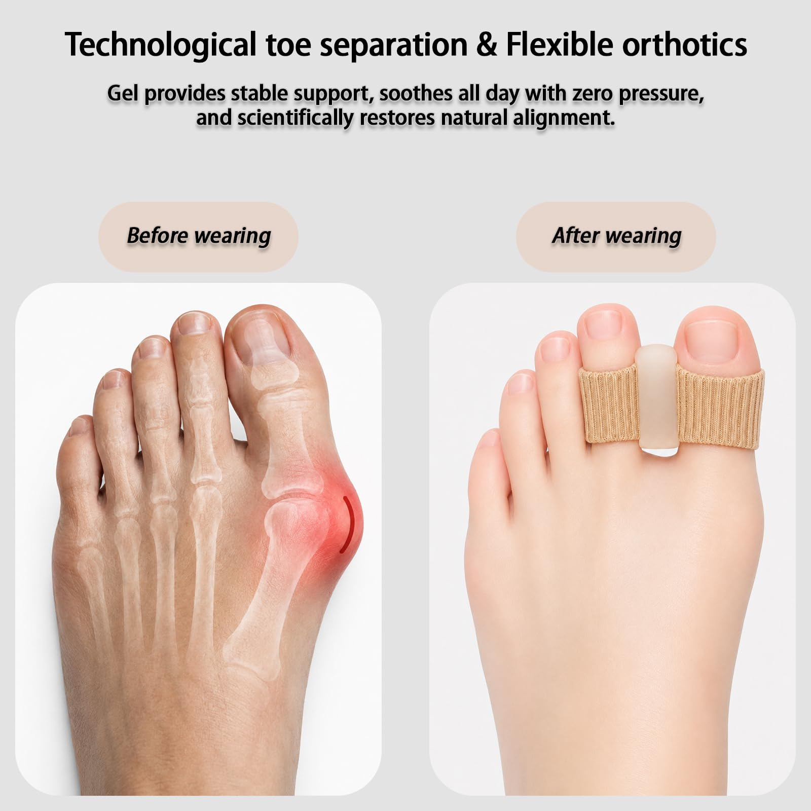 NUGRXIS Silicone Toe Spacers 4-Pack – Bunion Pain Relief