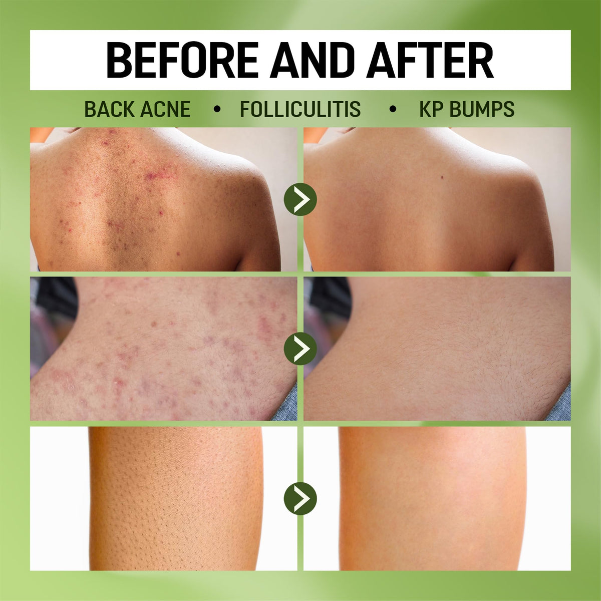 ABERA High Performance Folliculitis Treatment Body Wash Wild - ABERA Official Imagery - 3