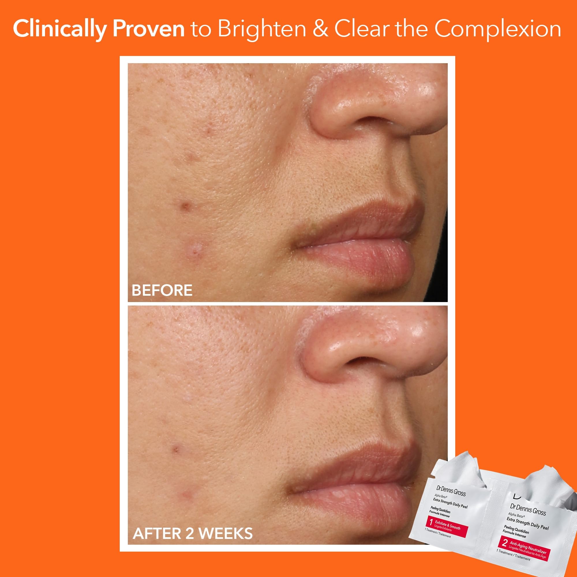 Dr Dennis Gross Alpha Beta Extra Strength Exfoliating Daily Peel - Dr Dennis Gross
