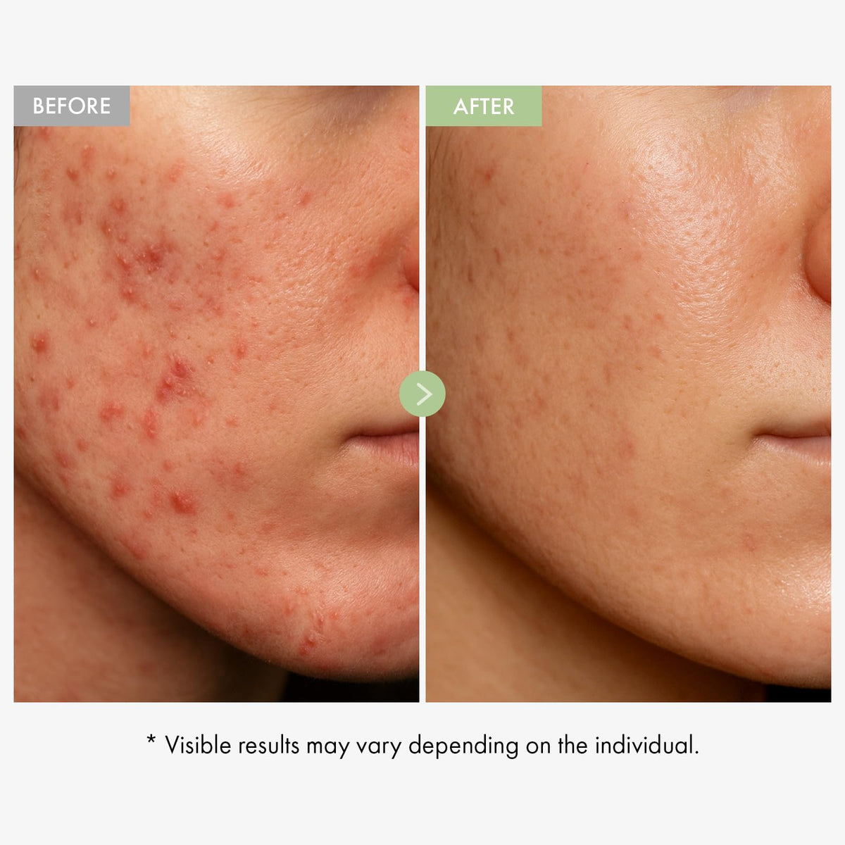 TOSOWOONG Exosome CICA Face Cream for Redness Blemish Prone - TOSOWOONG Official Imagery - 4