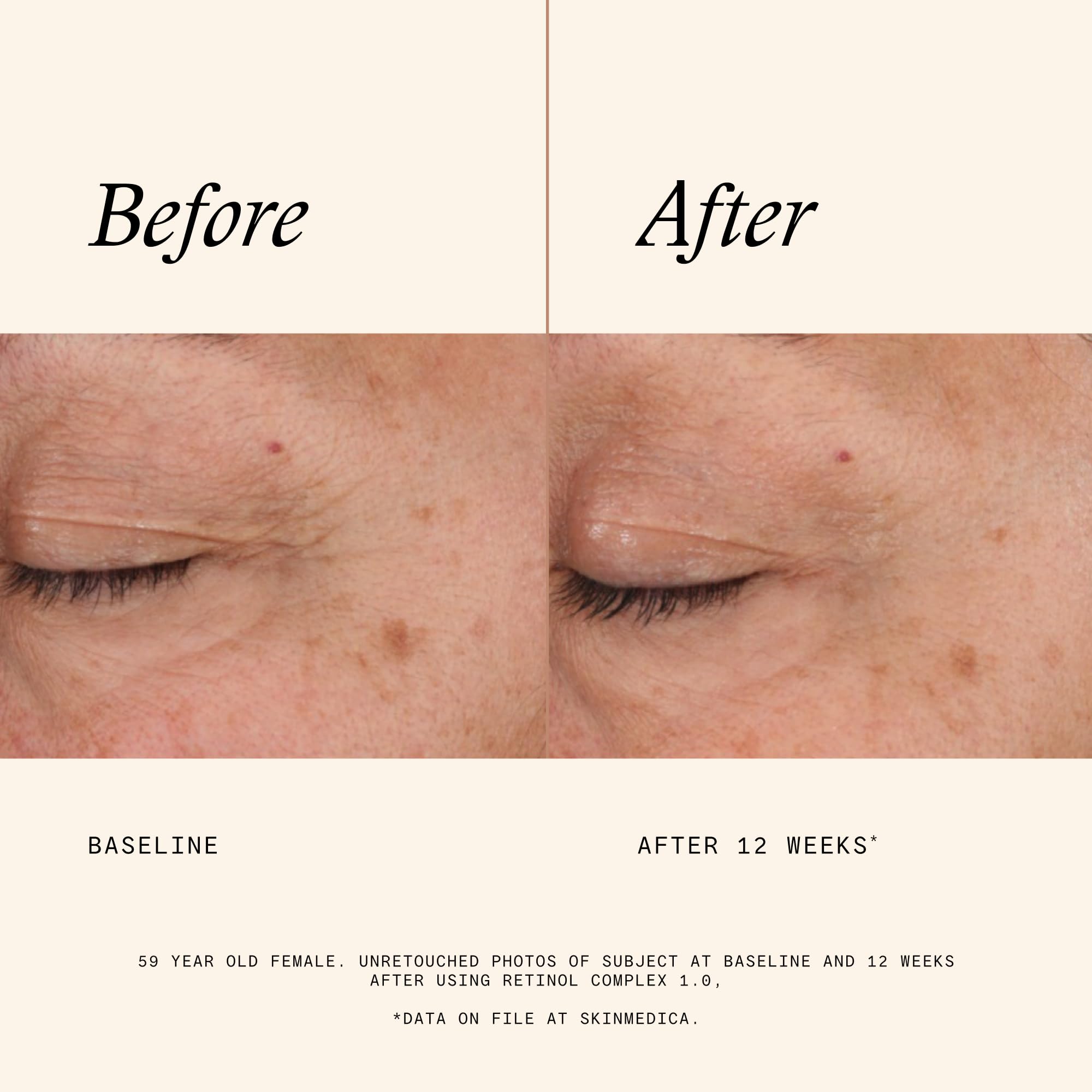 SkinMedica Retinol Serum 1.0 Complex - SkinMedica