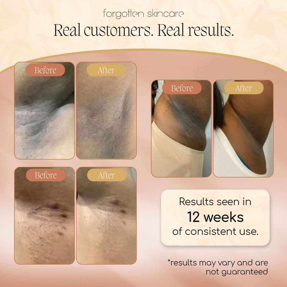 Forgotten Skincare Underarm Brightening Body Cream For Dark - Forgotten Skincare Official Imagery - 4